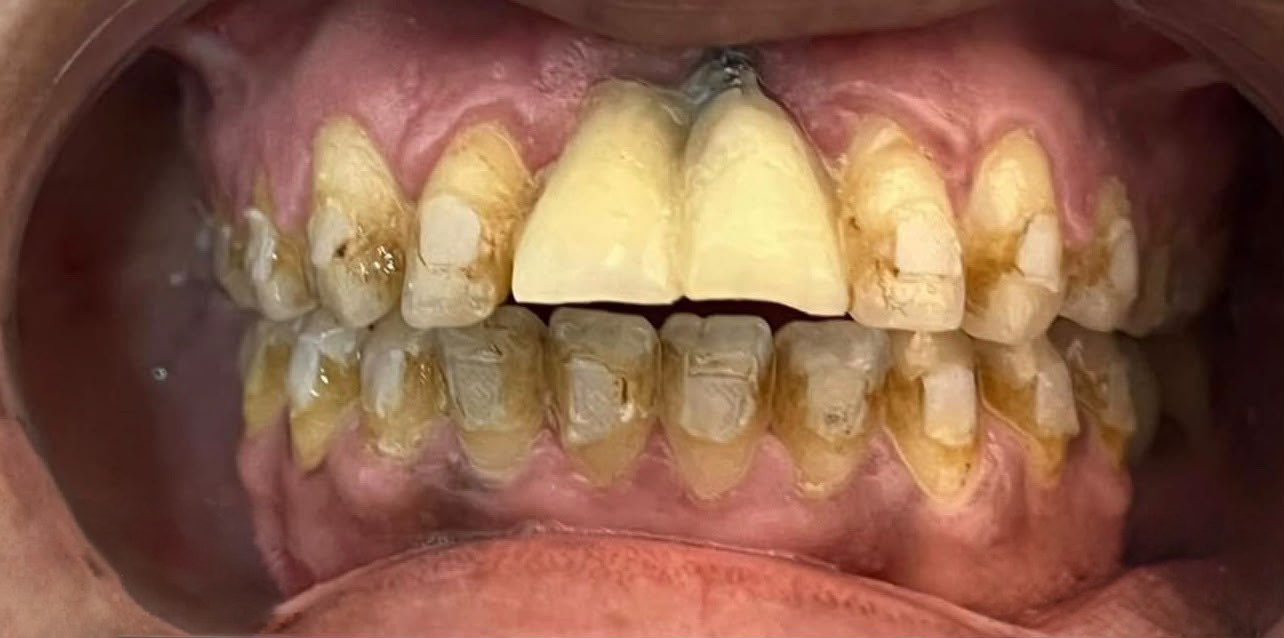 Antes: Rehabilitación estética