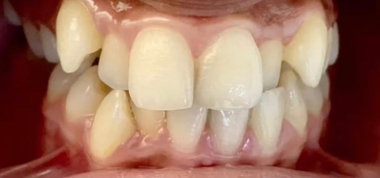 Antes: Alineación dental