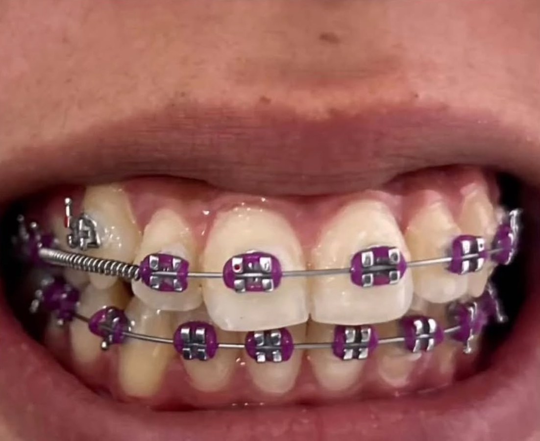 Después: Alineación dental